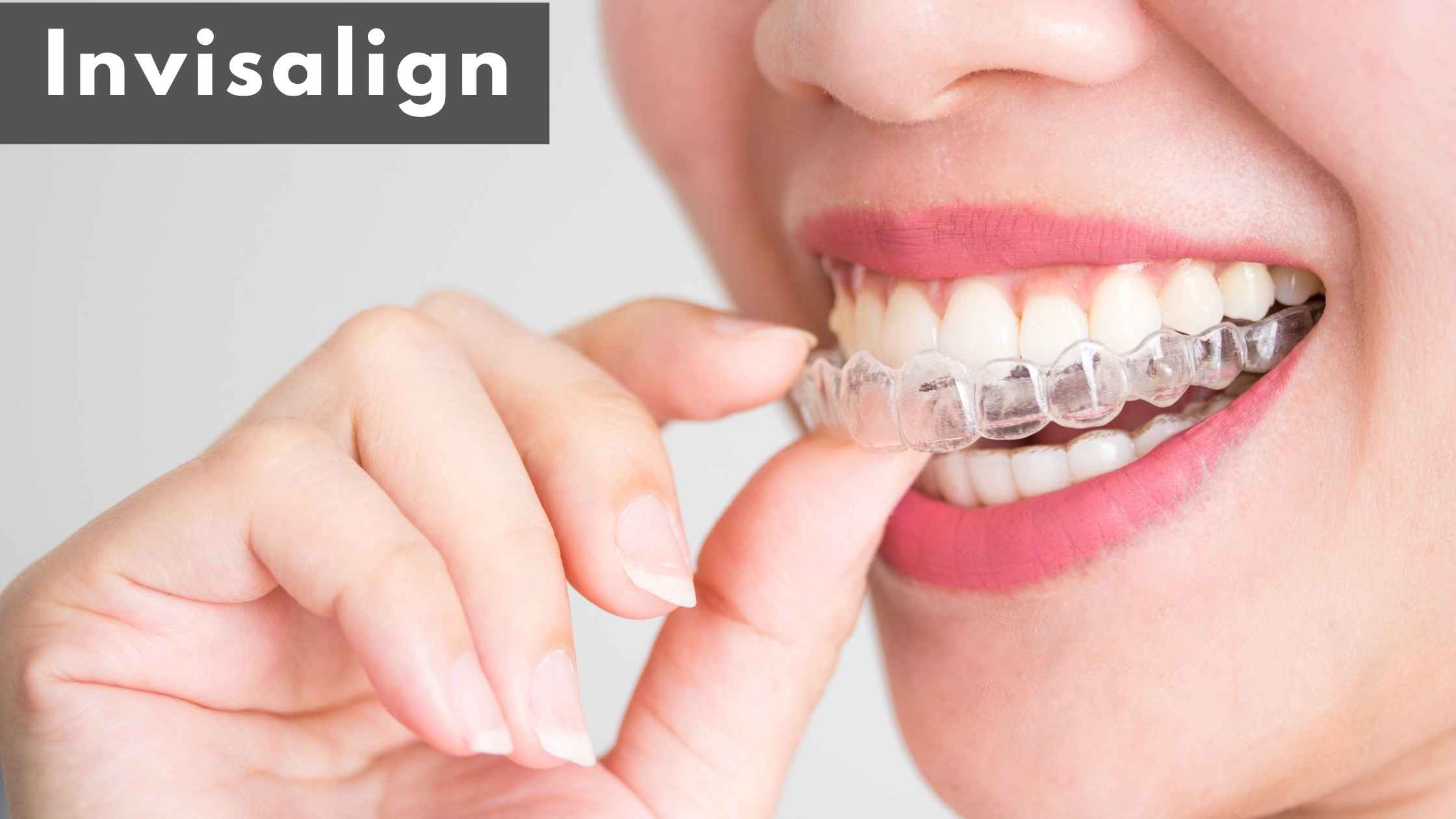 Invisalign
